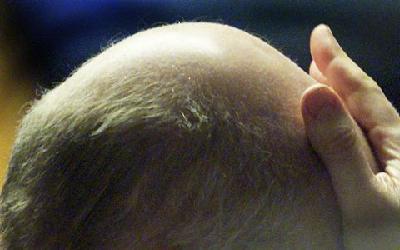 Exploring the long and short of hair loss